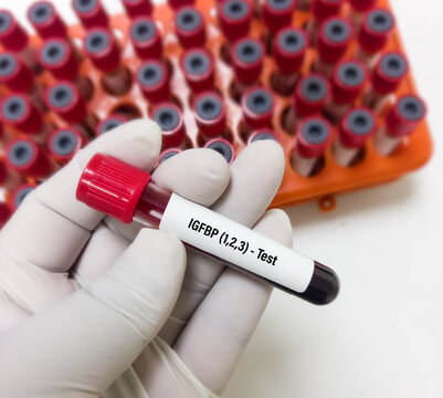 Blood samples for IGFBP(1, 2, 3) test or insulin like growth factor binding protein. IGF binding protein.