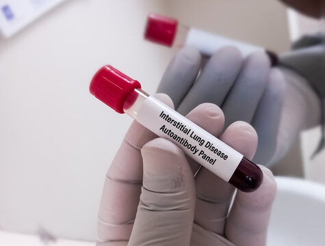 Technologist holds blood sample for Interstitial Lung Disease autoantibody panel test. to diagnosis of systemic autoimmune rheumatic disease.