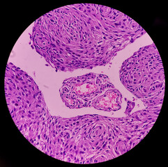Parietal lesion(biopsy): Brain cancer, Meningioma, show neoplasm of meningothelial cells with round...