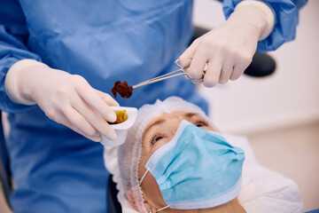 Close up of eye surgeon using surgical forceps with iodine gauze in operating room at the clinic.