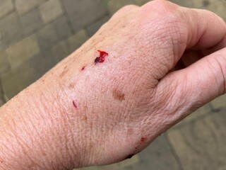 Close up of cat bite on older woman's hand