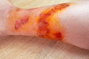 large healing wound from on lower leg with scars of adult female patient, redness, scarring skin,...
