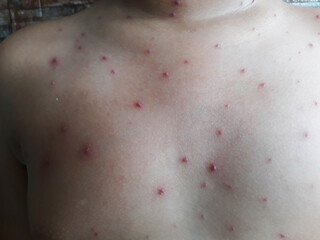 portrait of elementary age boy itching due to chickenpox. Wellness home care treatment chickenpox because varicella zoster virus