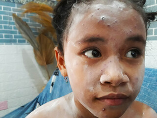 Selective focus portrait of elementary age girl using powder for itching due to chickenpox....