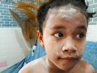 Selective focus portrait of elementary age girl using powder for itching due to chickenpox....