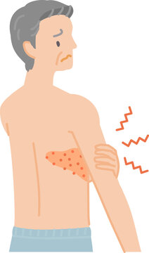 帯状疱疹：背中から胸にかけて痛みやかゆみ、腫れがあるシニア男性（後ろ姿）