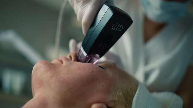 Precise Skin Rejuvenation: Fractional Radiofrequency Therapy for Effective Treatment of Hyperpigmentation, Wrinkles, and Enlarged Pores. High quality 4k footage