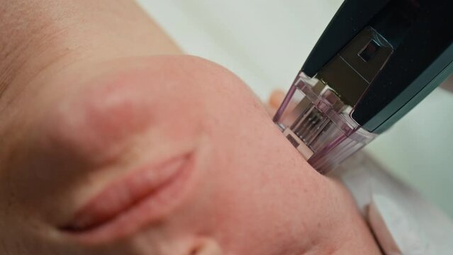 Advanced Beauty Treatment: Micro-Needling Therapy for Rejuvenating Mature Skin in a Cosmetology Clinic. High quality 4k footage