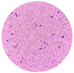 Blood smear, Hereditary hemolytic anemia. Hemoglobin E (HbE) disease. pencil cell, target cell, tear drop cell. occasional nRBC incresed. Thalassemia disease.
