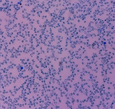 Reticulocyte count under microscope, 100x. methylene blue staining,reticulocyte count from blood smear