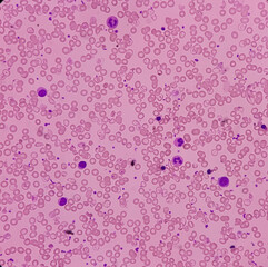 Blood smear, Hereditary hemolytic anemia. Hemoglobin E (HbE) disease. pencil cell, target cell, tear drop cell. occasional nRBC incresed. Thalassemia disease.