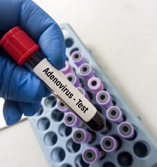 Blood sample for adenovirus test to diagnosis of Adenovirus infection. Rapid and PCR test.