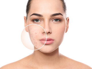 Woman with acne on her face on white background. Zoomed area showing problem skin