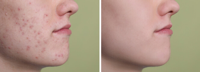 Acne problem. Young man before and after treatment on green background, closeup. Collage of photos