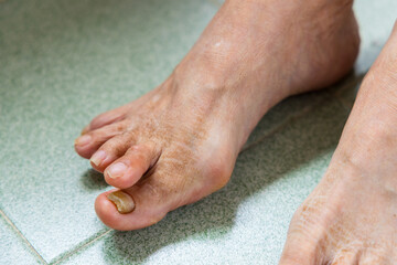 Asian woman suffer from serous Hallux Valgus over the feet toe