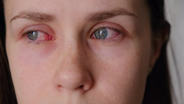 Close up of upset ill young caucasian woman suffering from eyes pain, looking at camera. Cause of pain include contact lens problem, conjunctivitis, foreign object, dry eye syndrome or allergy