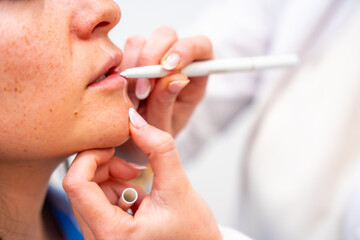 Marking the points of the lips to inject hyaluronic acid