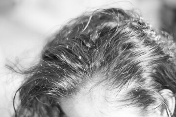 Flaky scalp is caused by dry skin. Allergy to cosmetics or has fungus, dandruff