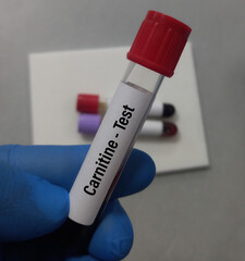 Fototapeta premium Blood sample for Carnitine test to diagnosis of primary carnitine deficiency for various muscle disorders.
