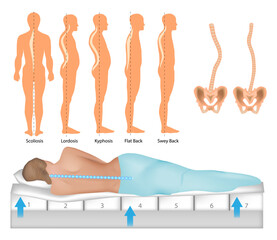 Orthopedic Mattress. Curvature Of Human Spine. The Influence of Mattress Stiffness on Spinal Curvature and Intervertebral Disc Stress.