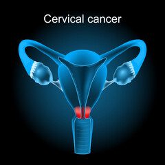 Cervical cancer. Cut-away view of the uterus.