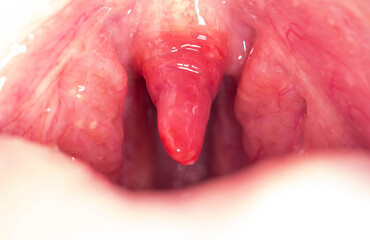 Long uvula with inflammation of infections and viruses. Treatment of uvulitis in children and...