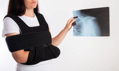 A girl holds an X-ray of a dislocation and fracture of the humerus in a bandage on the shoulder...