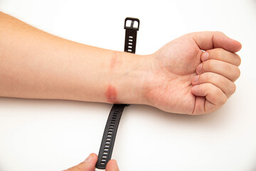 A fitness bracelet with a silicone strap taken from a person s hand. Redness, irritation and itching on the hand from the watch strap. Allergic contact dermatitis, close-up