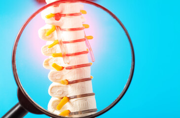 Model of the cervical spine with a compressed nerve root on a blue background under a magnifying glass. Concept of health and diseases of the spine. Orthopedics and vertebrology.  - 768872301