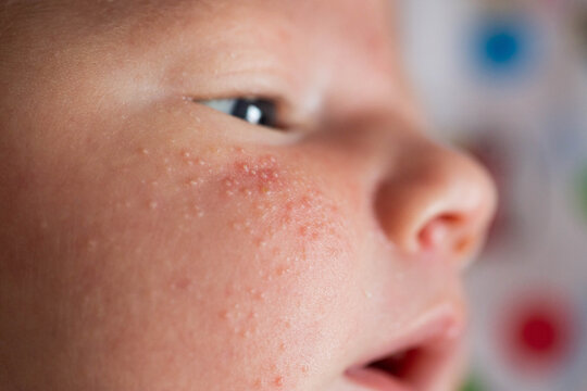 Allergic pimples in a newborn on the face. Pathogenesis, acne of newborns.