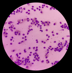 Lymphocytosis with Thrombocytopenia. Smear show white blood cells, red blood cells background. Lymphoproliferative disorder.