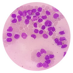 Lymphocytosis with Thrombocytopenia. Smear show white blood cells, red blood cells background....