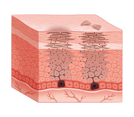 皮膚の断面（シミ発生のメカニズム）
