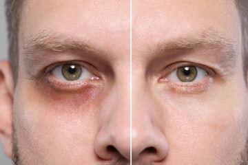 Collage with photos of man with dark circle under eye before and after treatment on beige...