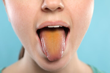 Gastrointestinal diseases. Woman showing her yellow tongue on light blue background, closeup