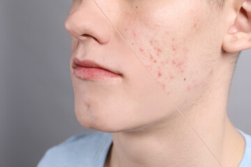 Obraz premium Acne problem, collage. Photo of man divided into halves before and after treatment on grey background, closeup