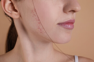 Acne problem, collage. Photo of woman divided into halves before and after treatment on beige background, closeup