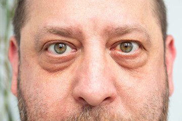 Close-up of a man's face: visible hemorrhage and redness of the eye, possible consequences of...