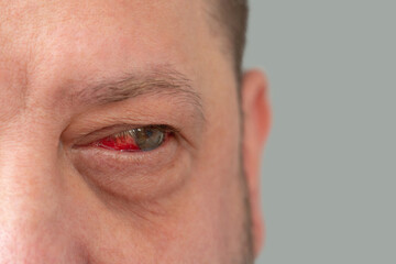 Hemorrhage due to capillary rupture in the man's eye. Detailed image of a man's face with a...