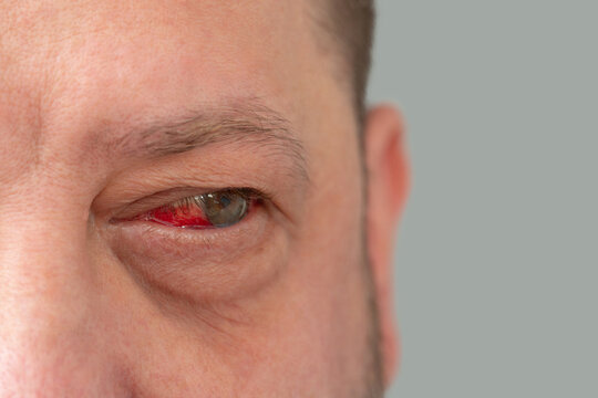 Hemorrhage due to capillary rupture in the man's eye. Detailed image of a man's face with a reddened eye.