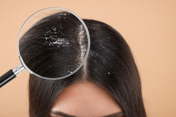 Woman suffering from dandruff on beige background, closeup. View through magnifying glass on hair...
