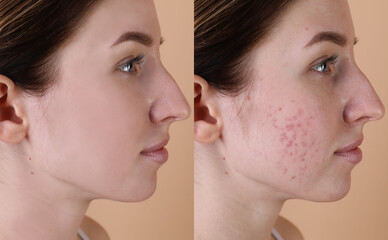 Acne problem. Young woman before and after treatment on beige background, collage of photos