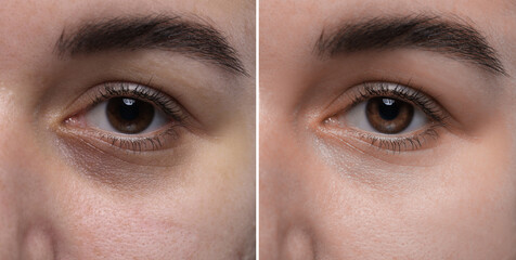 Collage with photos of woman with dark circle under eye before and after treatment, closeup