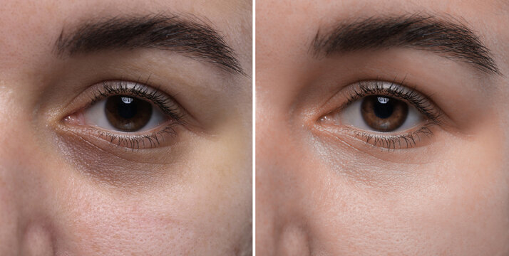Collage with photos of woman with dark circle under eye before and after treatment, closeup