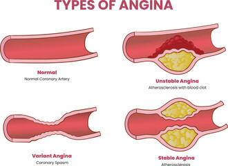 types of angina illustration