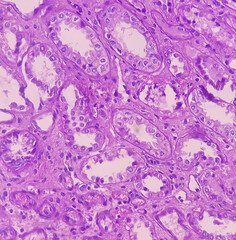 Kidney cancer: Clear cell carcinoma. fuhrman nuclear grade-II, Renal growth shows a malignant...