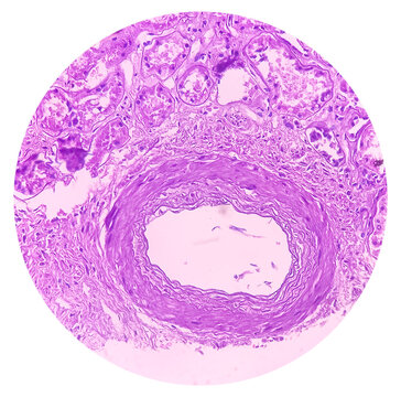 Kidney cancer: Clear cell carcinoma. fuhrman nuclear grade-II, Renal growth shows a malignant tumor, renal cell carcinoma in between renal tubules.