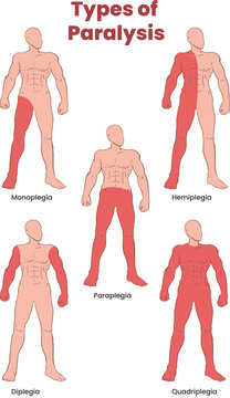 types of paralysis illustration