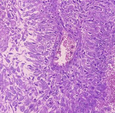 Kidney cancer: Clear cell carcinoma. fuhrman nuclear grade-II, Renal growth shows a malignant tumor, renal cell carcinoma in between renal tubules.