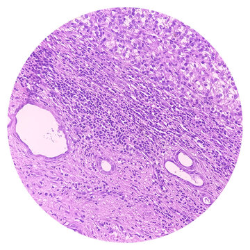 Kidney cancer: Clear cell carcinoma. fuhrman nuclear grade-II, Renal growth shows a malignant tumor, renal cell carcinoma in between renal tubules.